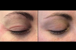 how to treat eczema on eyelids Clinic in islamabad