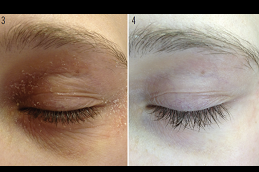 how to treat eczema on eyelids in rawalpindi