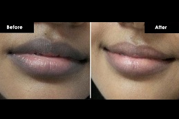lips color treatment in islamabad