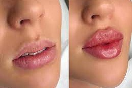 lips color treatment in rawalpindi