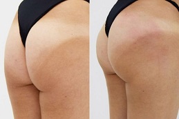 non surgical bum lift in ISLAMABAD