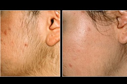 permanent facial hair removal in ISLAMABAD