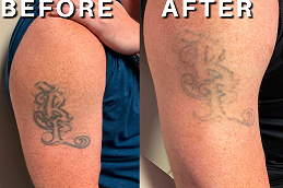 picosure tattoo removal in ISLAMABAD