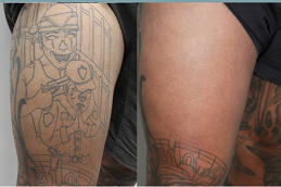 picosure tattoo removal in RAWALPINDI