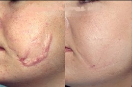 post-surgical-scars-treatment Clinic in islamabad