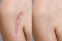 post-surgical-scars-treatment in islamabad