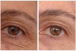 prp treatment for dark circles cost Clinic in islamabad