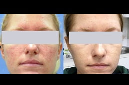 rosacea-treatment-2 Clinic in islamabad