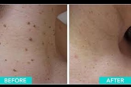 skin lesion removal in ISLAMABAD