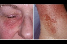 skin rashes types causes treatment in RAWALPINDI