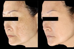 sylfirm-x-treatment Clinic in islamabad