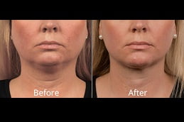 sylfirm-x-treatment in islamabad