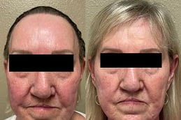 sylfirm-x-treatment in rawalpindi