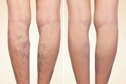 varicose veins treatment Clinic in islamabad