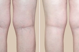 varicose veins treatment in islamabad