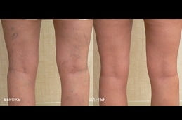 varicose veins treatment in rawalpindi