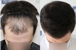 2000 and 3000 grafts hair transplant cost in islamabad