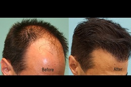 2000 and 3000 grafts hair transplant costclinic in islamabad