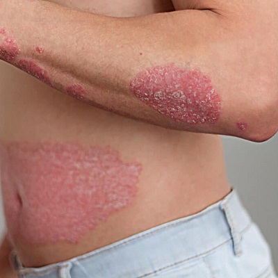 Best Doctors for Psoriasis Treatment in Islamabad