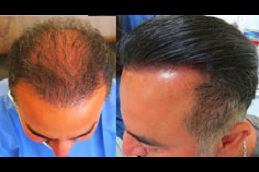 Best biofibre hair transplant cost clinic in islamabad