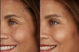 Best botox for wrinkles treatment Clinic in islamabad