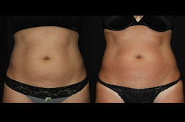 Best coolsculpting fat freezing Clinic in islamabad