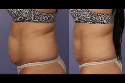 Best coolsculpting fat freezing in rawalpindi