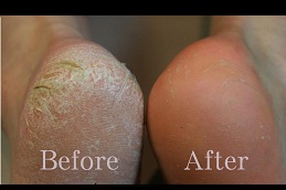 Best cracked heels treatment Clinic in islamabad