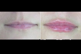 Best dark lips treatment clinic in islamabad