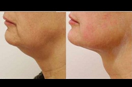 Best dull neck skin treatment in rawalpindi