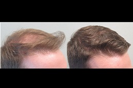 Best finasteride for hair loss clinic in islamabad