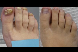 Best fungal nail infections Clinic in islamabad