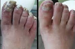 Best fungal nail infections in rawalpindi