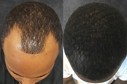 Best hair transplant for black males Clinic in islamabad