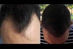 Best hair transplant for black males in rawalpindi