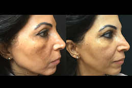 Best how to treat melasma Clinic in islamabad