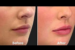 Best lip-augmentation Clinic in Islamabad