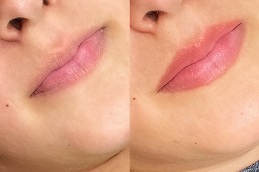 Best lip tinting Clinic in islamabad