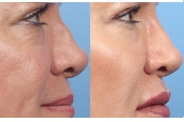 Best nose fillers injections Clinic in islamabad