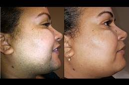 Best permanent facial hair removal for women in rawalpindi