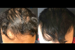 Best threads for hair growth Clinic in islamabad
