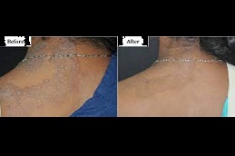 Best tinea treatment Clinic in islamabad