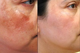 Best treatment for pigmentation on face Clinic in islamabad