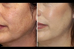 Best treatment for pigmentation on face in rawalpindi