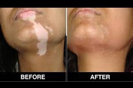 Best vitiligo treatment Clinic in islamabad