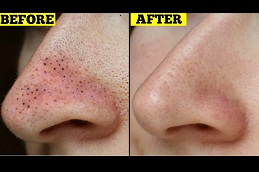 Best whitehead blackhead removal Clinic in islamabad