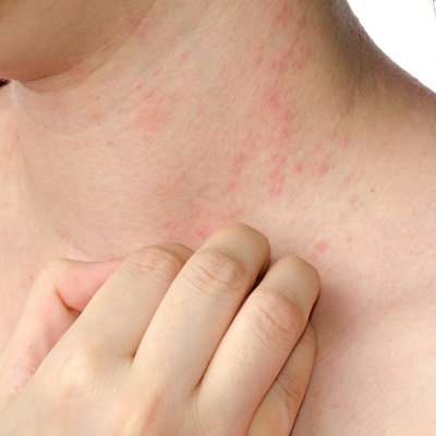 Eczema Treatment Pros and Cons