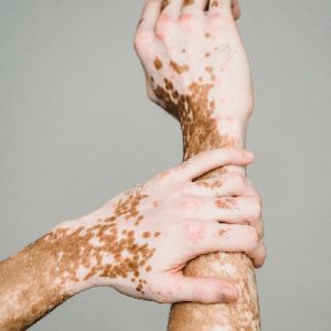 How Does Autoimmune Disease Affect Skin