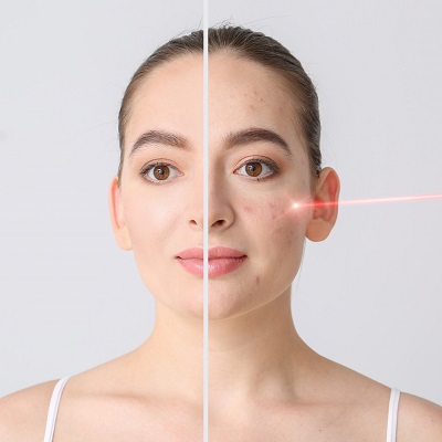 Is laser Treatment for Acne Scars Permanent in Islamabad Price