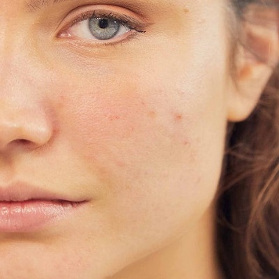 Large Pores Treatment 3 Proven Ways